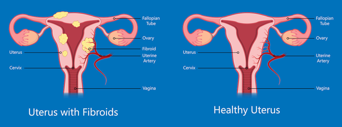 31 Uterine Fibroids Signs And Symptoms